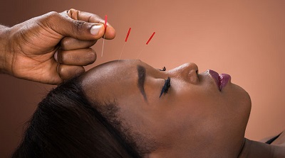 acupuncture.jpg acupuncture.jpg