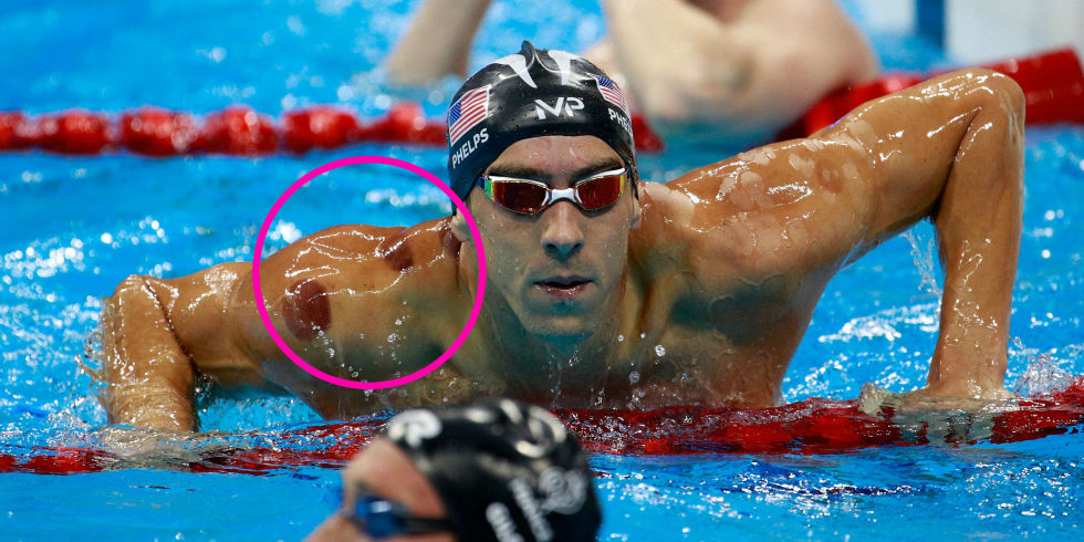 At the 2016 Summer Olympics, Michael Phelps has generated a lot of buzz, and not just because of his medals! People are asking what the circular marks on his shoulders and back are and, for many, learning about cupping for the first time.